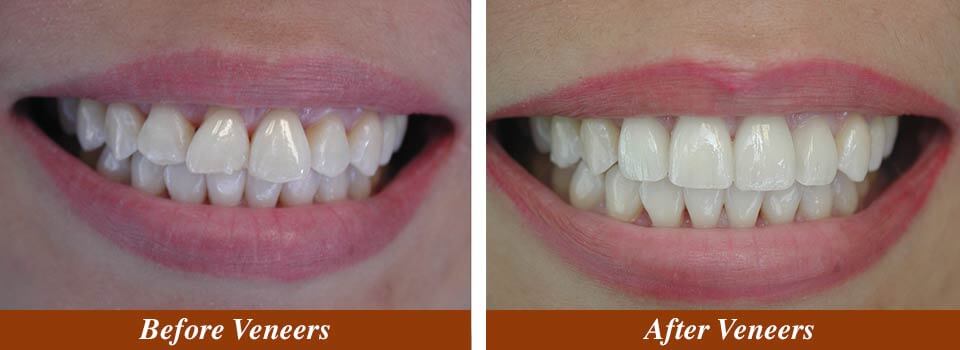 Veneer Case Before and After