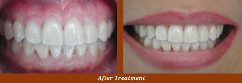 veneer cases in arlington va