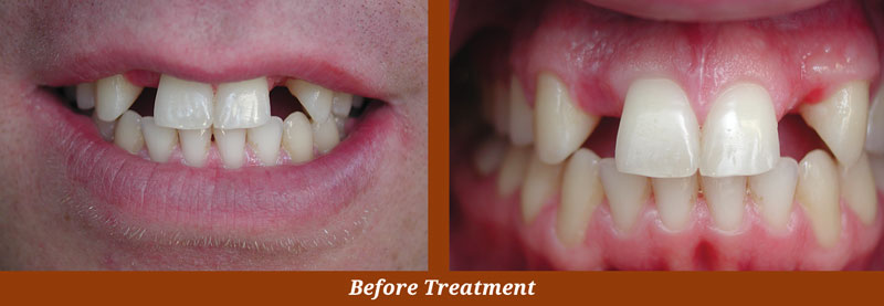 implant cases in centreville, va