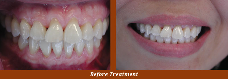 veneer cases in centreville va