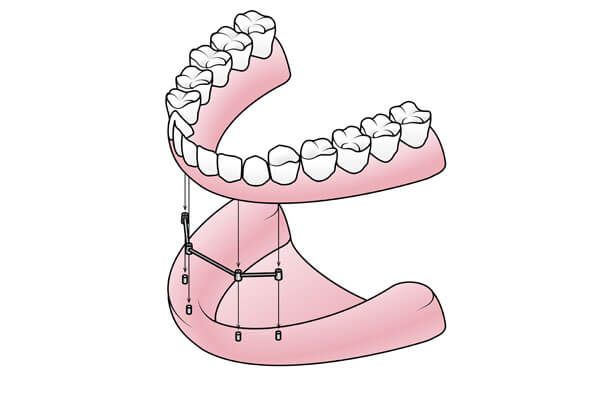 implant denture dentist