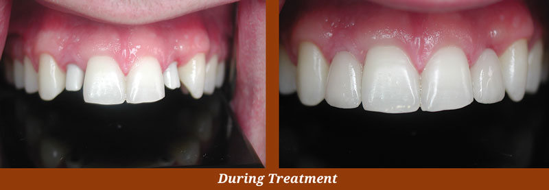 implant cases in arlington, va