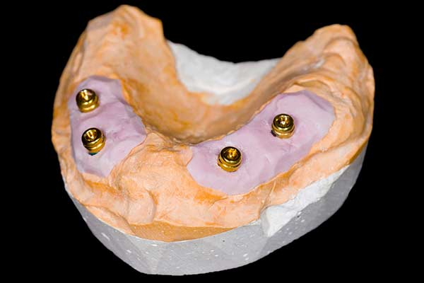 implant denture in centreville, va
