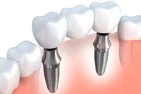 Implant Bridge in Centreville, VA