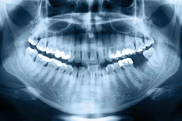 Implant Bridge dentist 